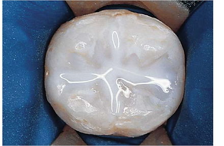 Close-up of a molar tooth with dental sealant under a blue dental dam.