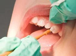 Close-up of a dental procedure with a dentist applying fluoride varnish to teeth using an orange paintbrush-like tool.