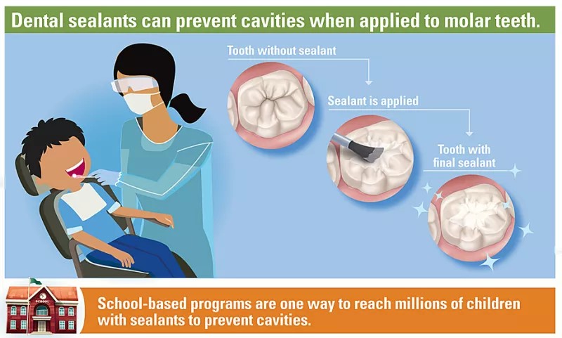 Dental sealants can prevent cavities when applied to molar teeth.